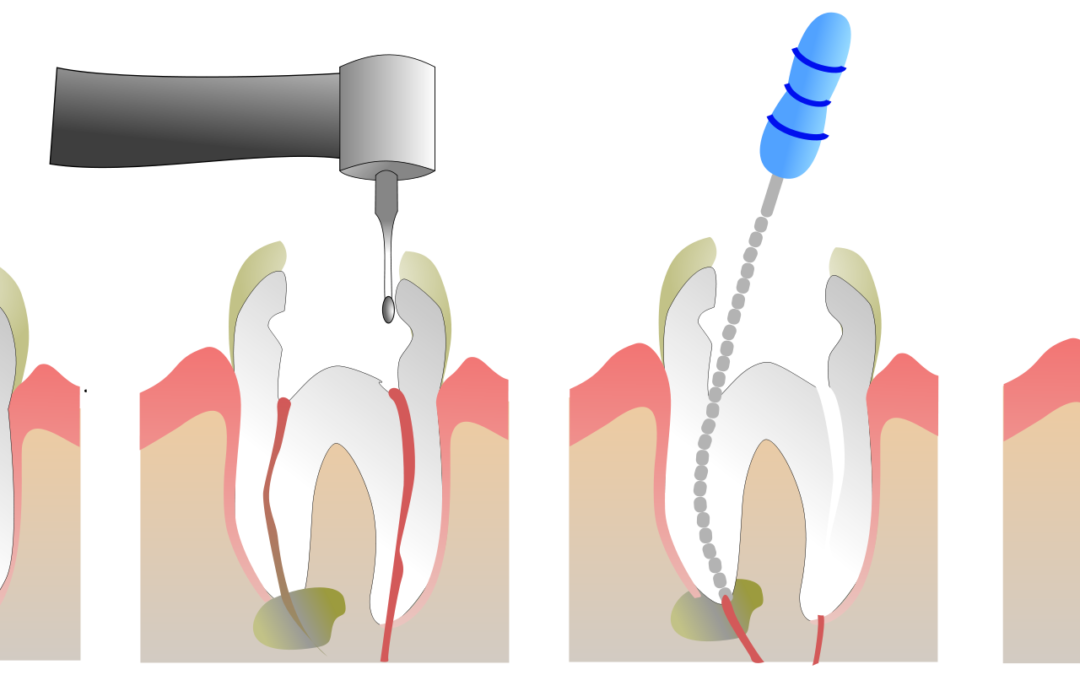 Endodonzia