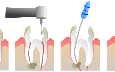 Endodonzia