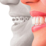 invisalign2