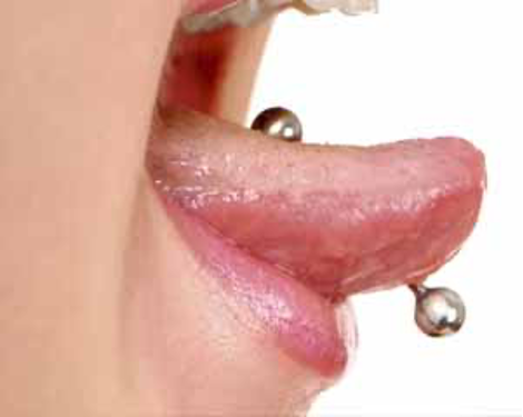 Piercing linguale: conseguenze per gengive e impianti