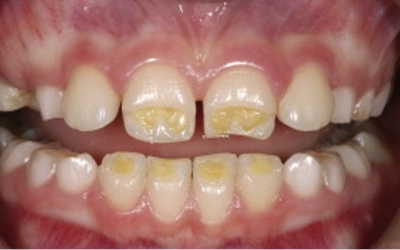 Celiachia ed effetti sui denti