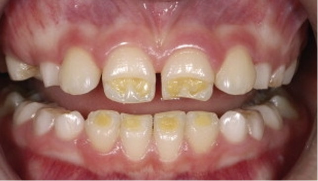 Celiachia ed effetti sui denti