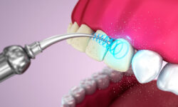 Le sedute di pulizia dal dentista danneggiano i denti?